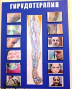 Гирудотерапия