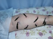 Гирудотерапия - лечение пиявками