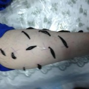 Лечение пиявками