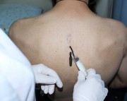 Снятие пиявки