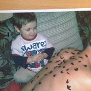 Гирудотерапия